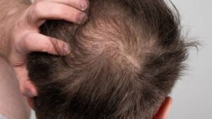 are hair transplants safe